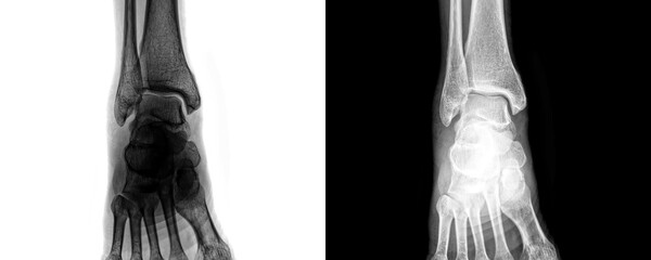 Radiology Image of Ankle Joint in Anterior View X-Ray Used for Fracture Detection and Bone...