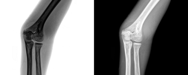 X-Ray of Elbow Anterior View Demonstrating Skeletal Framework and Bone Anatomy for Fracture Detection Isolated on Transparent or White Background