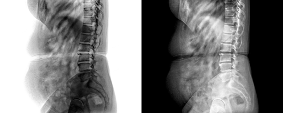 Lateral View Lumbar Spine X-Ray Showing Vertebral Alignment and Skeletal Anatomy for Lower Back Pain Isolated on a Transparent or White Background