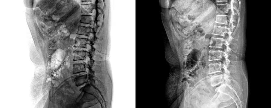 X-Ray of Human Lumbar Spine in Lateral View of Vertebrae and Skeletal Structure for Lower Back Pain Isolated on a Transparent or White Background