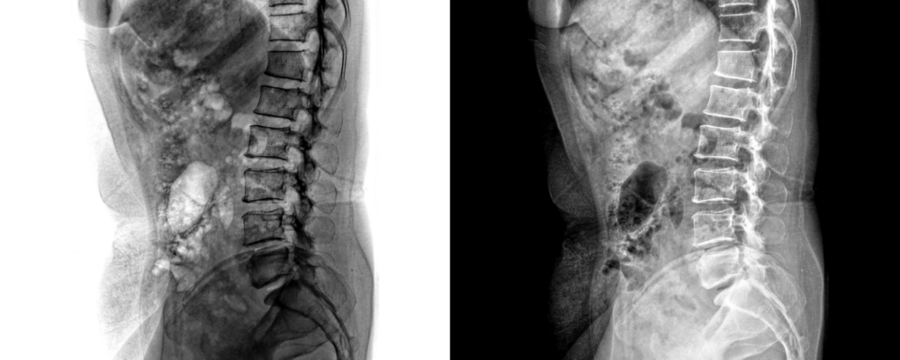 X-Ray of Human Lumbar Spine in Lateral View of Vertebrae and Skeletal Structure for Lower Back Pain Isolated on a Transparent or White Background