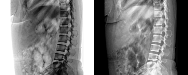 Radiology Image of Human Lumbar Spine in Lateral View X-Ray Used for Evaluation of Lower Back Pain Isolated on a Transparent or White Background