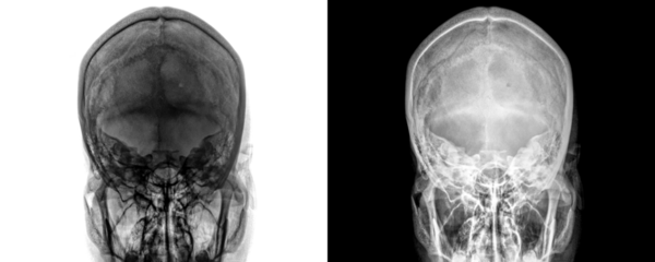X-Ray of Mastoid Townes View Depicting Mastoid Air Cells and Temporal Bone Structure Isolated on a Transparent or White Background