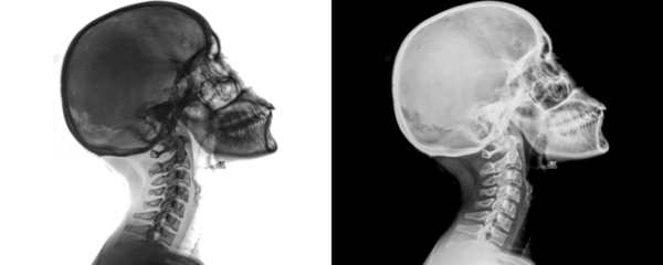 X-Ray of Human Neck in Lateral View of Cervical Vertebrae and Soft Tissue Anatomy Isolated on a Transparent or White Background