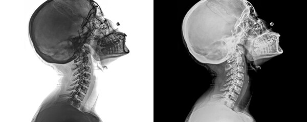 Human Neck Lateral View X-Ray of Cervical Spine Curvature and Soft Tissue Anatomy for Diagnosis Isolated on a Transparent or White Background