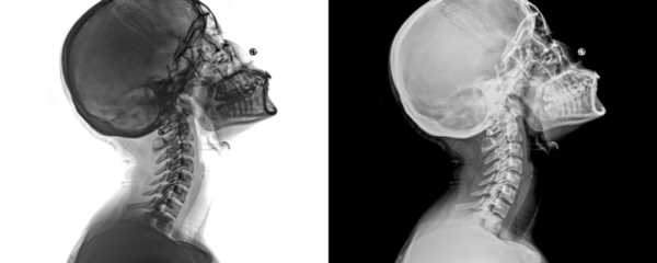 Human Neck Lateral View X-Ray of Cervical Spine Curvature and Soft Tissue Anatomy for Diagnosis Isolated on a Transparent or White Background