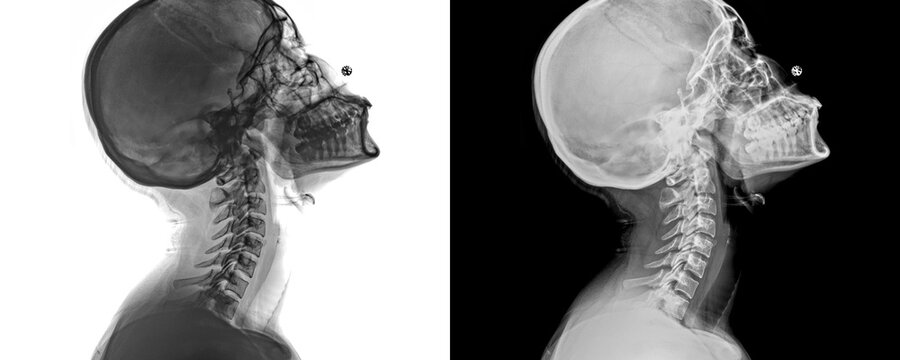 Human Neck Lateral View X-Ray of Cervical Spine Curvature and Soft Tissue Anatomy for Diagnosis Isolated on a Transparent or White Background