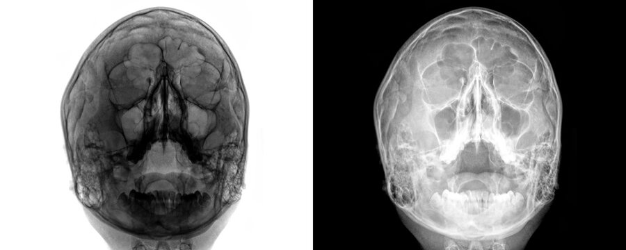 PNS PA View X-Ray Showing Frontal Sinuses and Nasal Structures for Diagnostic Evaluation Isolated on a Transparent or White Background