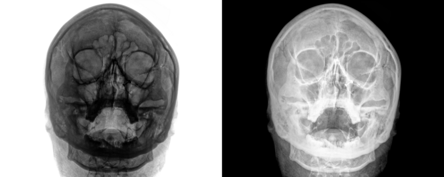 X-Ray of Paranasal Sinuses in PA View Depicting Frontal Sinus Anatomy for Accurate Diagnosis Isolated on a Transparent or White Background