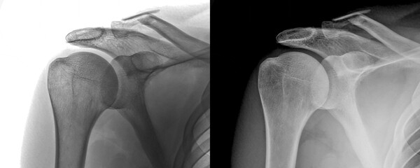 Shoulder Anterior View X-Ray of Bone and Joint Anatomy for Diagnosis of Injury Prediction Isolated...
