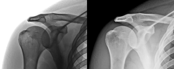 X-Ray of Shoulder in Anterior View Depicting Humeral Head and Glenoid Cavity for Assessment...