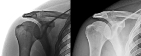 X-Ray of Shoulder in Anterior View Depicting Humeral Head and Glenoid Cavity for Assessment Isolated on a Transparent or White Background
