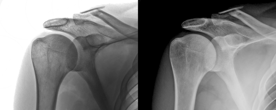 Shoulder Anterior View X-Ray of Bone and Joint Anatomy for Diagnosis of Injury Prediction Isolated on a Transparent or White Background