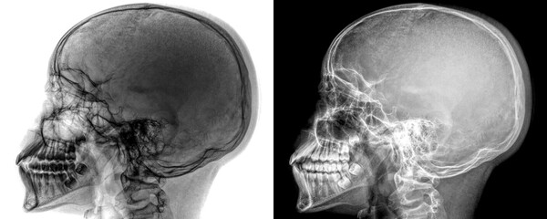 Skull Lateral View X-Ray Radiograph Showing Cranial and Facial Bone Structures for Sinus Evaluation...