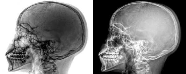 Skull Lateral View X-Ray Radiograph Showing Cranial and Facial Bone Structures for Sinus Evaluation Isolated on a Transparent or White Background