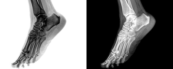 Foot Lateral View X-Ray Radiograph Showing Bone and Joint Anatomy for Fracture Detection,...
