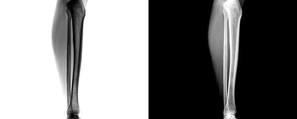 Leg Lateral View X-Ray Showing Tibia and Fibula Alignment for Fracture Detection, Bone Integrity...