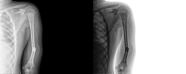 Arm Anterior View X-Ray Showing Humerus, Radius, and Ulna Alignment for Diagnosing Fractures,...