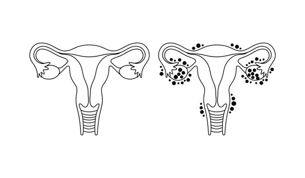 Illustration comparing a healthy uterus and fallopian tubes with one showing signs of disease or blockage.