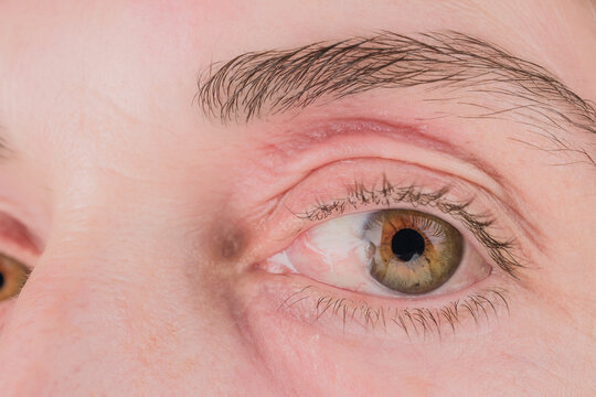 Mature woman eye showing pterygium disease