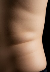 Close view of skin with noticeable fat deposits beneath the surface causing a puckered texture. Focus on common body appearance issue ,health ,close-up ,subcutaneous