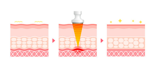 Vector illustration of HIFU mechanism and effect.