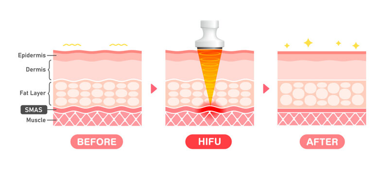 Vector illustration of HIFU mechanism and effect.
