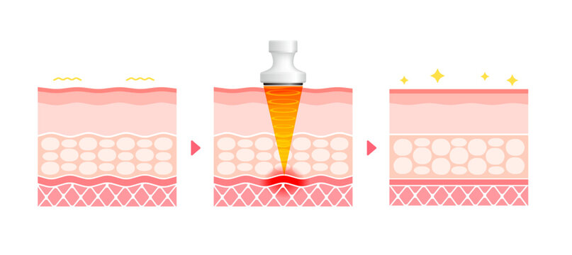 Vector illustration of HIFU mechanism and effect.