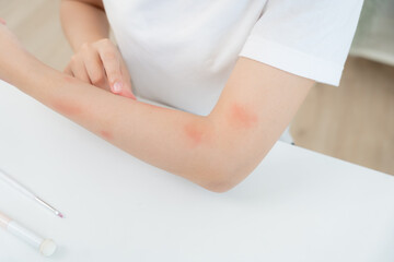 skin problem and beauty. Young woman scratch body has itchy skin from skin allergic, steroid allergy, sensitive skin, red from sunburn, chemical allergy, rash, insect bites, Seborrheic Dermatitis.