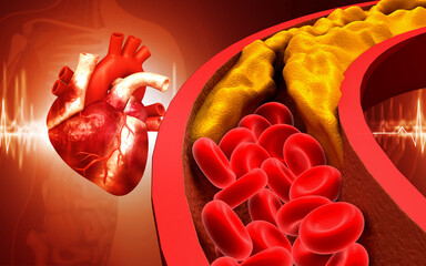 Blood vessel blockage, Heart attack, coronary artery disease and atherosclerosis condition. 3d illustration