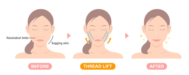 Vector illustration of how a thread lift works