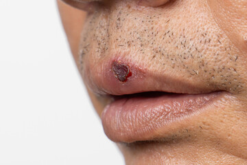 Cold Sore Blisters on Upper Lip of Asian Senior Man with Oral Herpes.