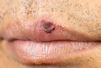 Herpes Simplex Virus (HSV-1) Infection, Close-up of Mouth Blisters on Elderly Man's Lip.