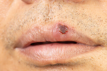 Cold Sore Blisters on Upper Lip of Asian Senior Man with Oral Herpes.