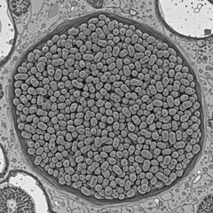 Plant Virus Aggregates Forming Crystalline Inclusion Body in Host Cell Transmission Electron Micrograph
