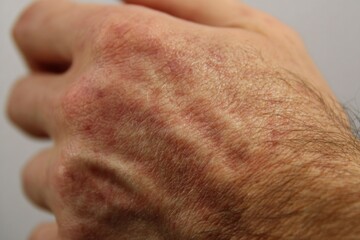 Fototapeta premium Neurotransmitter-Induced Skin Allergies: Imbalances in neurotransmitters may be associated with allergic skin reactions.