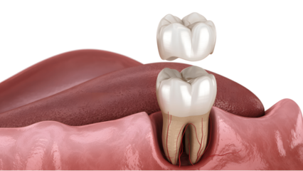 Dental crown isolated on transparent background placement