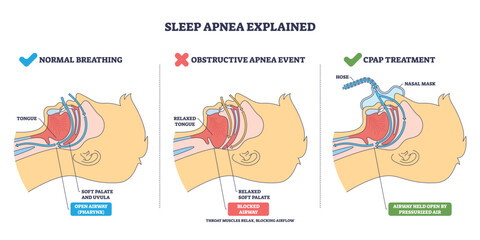 Normal breathing overview shows airflow, tongue and soft palate shape open vs blocked airway. CPAP holds airway open. Key objects, airway, tongue, nasal mask. Outline diagram