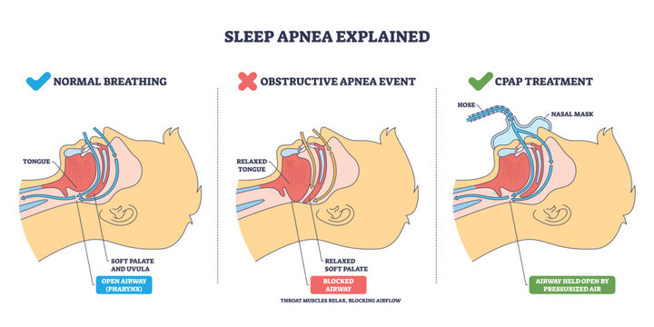 Normal breathing overview shows airflow, tongue and soft palate shape open vs blocked airway. CPAP holds airway open. Key objects, airway, tongue, nasal mask. Outline diagram