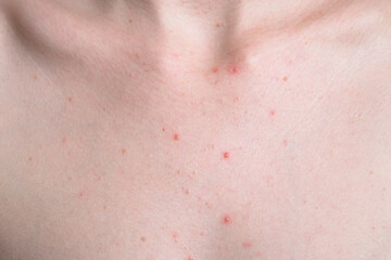 Close-up of a neck showing several small red pimples on light skin. The skin appears smooth with visible blemishes and a natural texture.