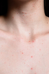 Close-up of a neck showing several small red pimples on light skin. The skin appears smooth with visible blemishes and a natural texture.