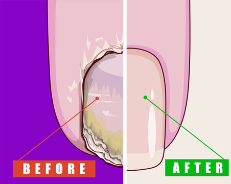 Nail plate disease. Healing of the nail plate. Before after. Tender manicure. Healthcare illustration. Vector illustration. 