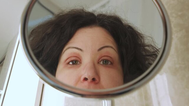 Caucasian woman observing her swollen eyes with red allergic reaction in the mirror. Eczema or peeling psoriasis on face skin. Inflamed dry skin, dermatological disease. Female iris hetero chromia.