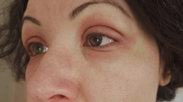 Caucasian woman showing her swollen eyes with red allergic reaction. Eczema or peeling psoriasis on face skin. Inflamed dry eyelid skin, dermatological disease. Beautiful female iris hetero chromia.