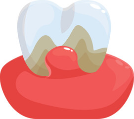Periodontitis causing swollen gums and bleeding, damaging a tooth with caries and dental plaque