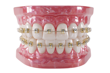 Dental model with gold and silver braces on white teeth pink gums orthodontics, Isolated On Transparent Background, Png Cut Out