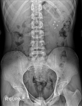 Abdominal and Pelvic X-ray in Supine Position Showing Lumbar Spine, Pelvis, and Radiopaque Objects in Right Upper Quadrant