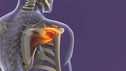 Shoulder Joint Inflammation Due to Rotator Cuff Strain