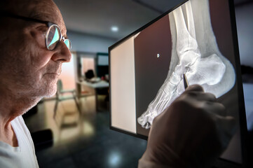 Podiatry Exam: Doctor Analyzing Foot and Ankle X-Ray On Monitor During Clinic Visit