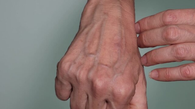 A close-up of a 58-year-old woman's hands, showing prominent veins. The subcutaneous fat layer is absent, the skin is thin, and the veins are visible through it. Cosmetology and plastic surgery.